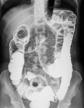 Röntgenbild vom Kolon
